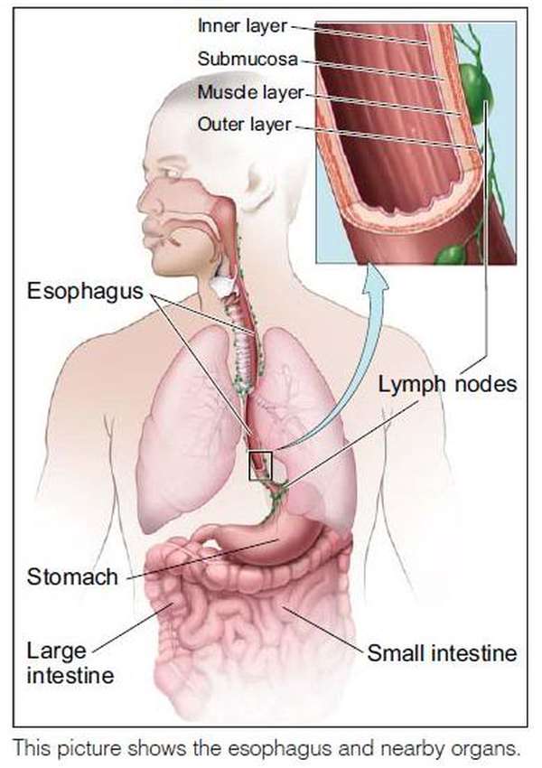 Esophageal Atresia - Hình ảnh minh họa